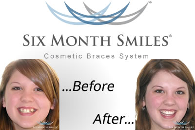 6 Month Smiles Orthodontics