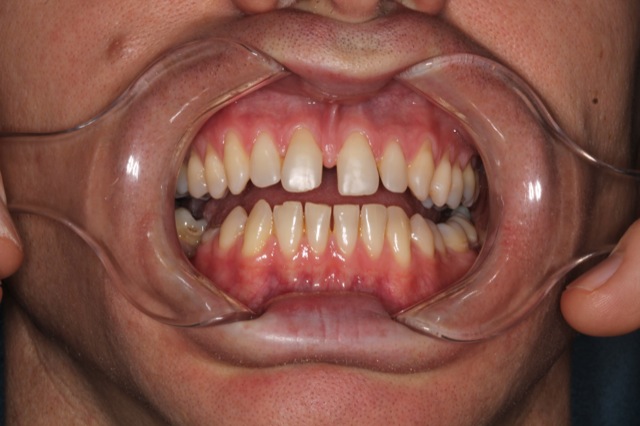 Teeth Before Treatment
