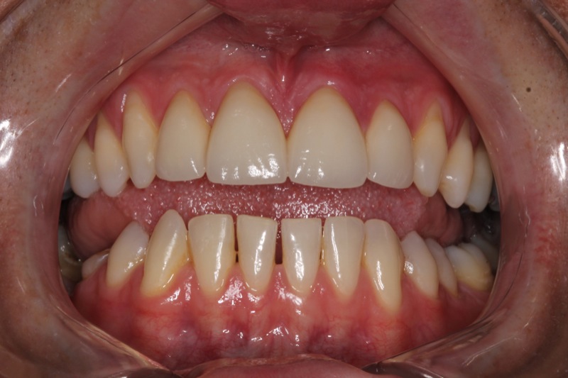 Teeth After Treatment