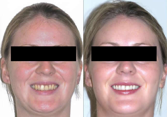 Porcelain Veneers & Bonding