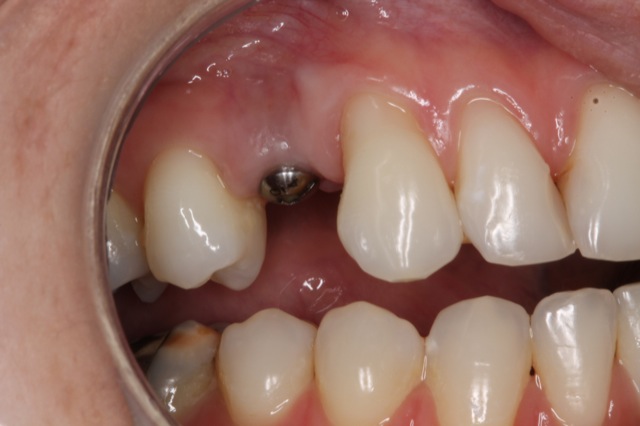 Dental Implants