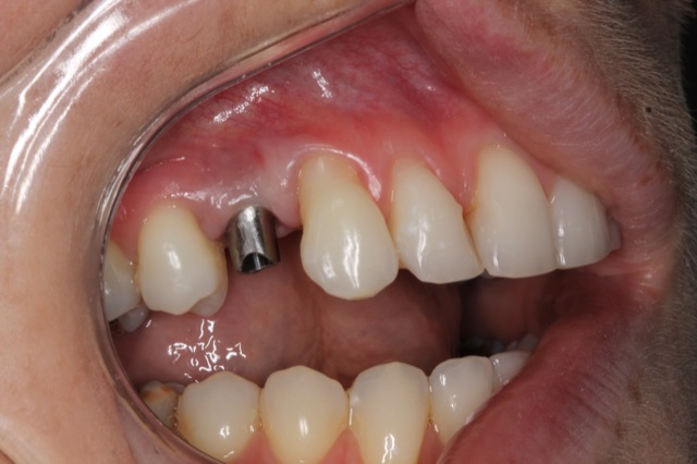 Implant Case 2 Multi-Tooth Bridge