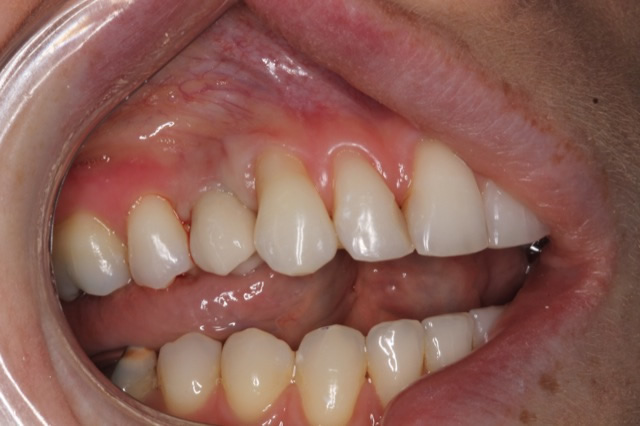 Implant Case 3 Full Arch Stabilization