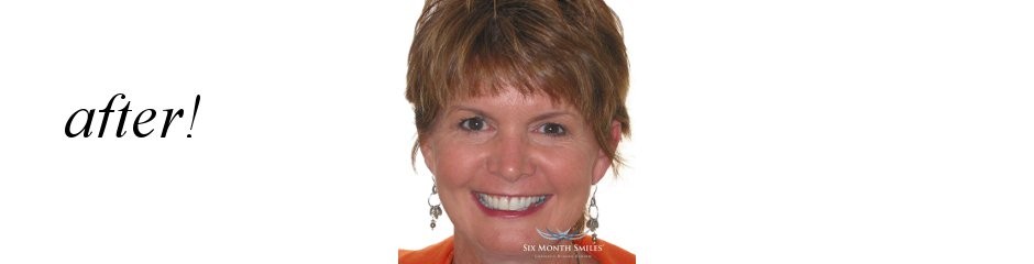 After Six Month Smiles