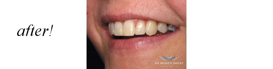 Case 3: Symmetrical Smile Arch Balance