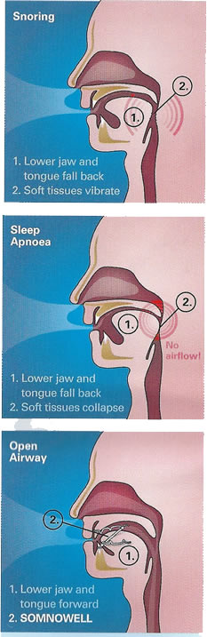 Snoring & Sleep Apnoea